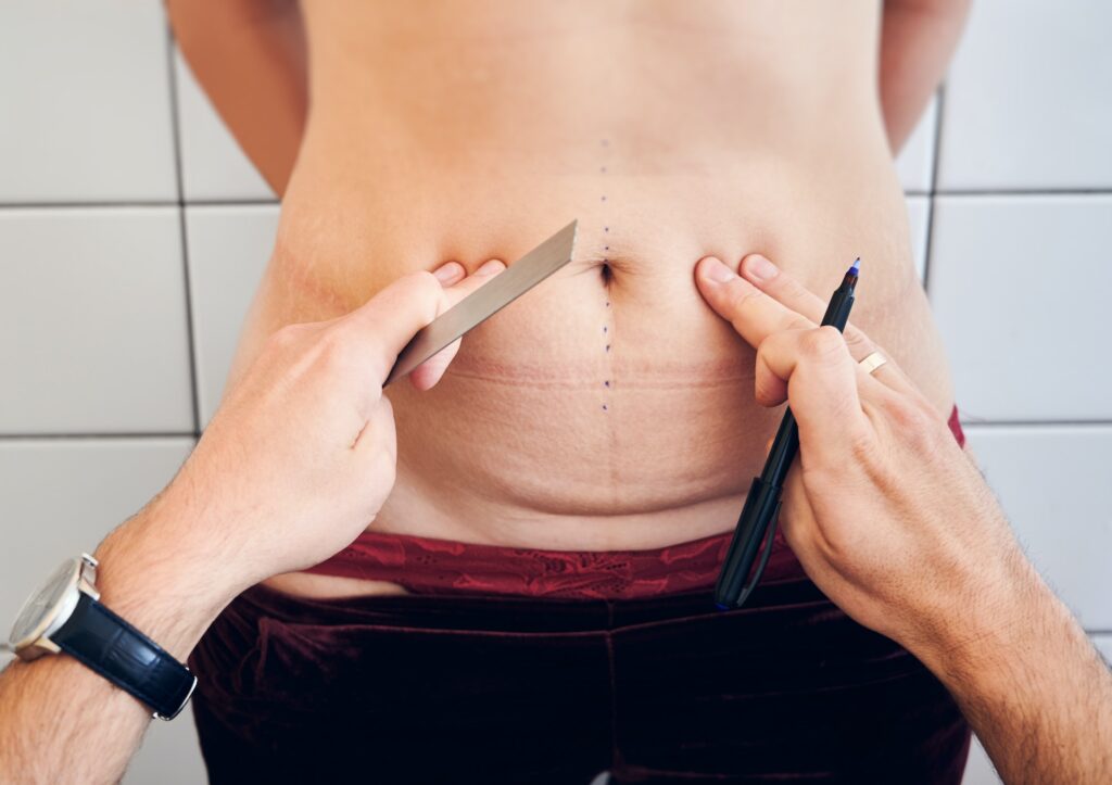 Plastic surgeon checking female abdomen before surgery.
